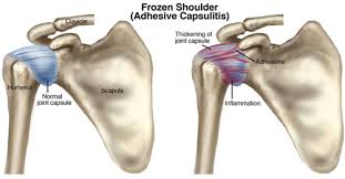 Causes and Treatment Frozen Shoulder