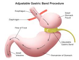 Define and Discuss on Gastric Banding