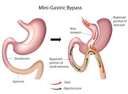 Effects of Gastric Bypass Surgery