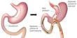 Recovery Process of Gastric Bypass Surgery