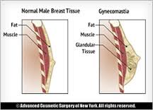 Define and Discuss on Gynecomastia