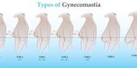 Treatment of Gynecomastia