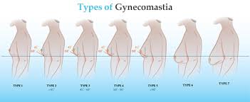 Treatment of Gynecomastia