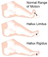 Medical Treatment of Hallux Limitus