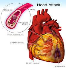 Treatment to Reduce Heart Attacks