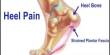 Reasons of Heel Pain