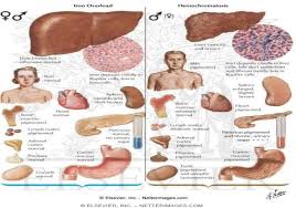Treatment and Symptoms of Hemochromatosis