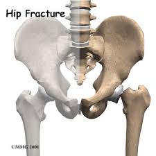 Different Types of Hip Fractures