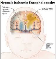 Define Hypoxic Ischemic Encephalopathy