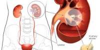 Make Perception about Kidney Stone Treatment