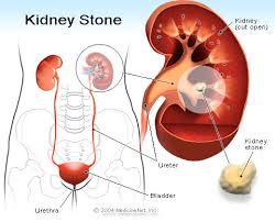 Make Perception about Kidney Stone Treatment