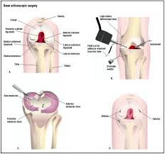 Procedure of Knee Dislocation Surgery