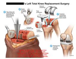 Explain Knee Replacement Surgery Operation