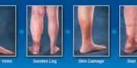 Causes of Leg Swelling