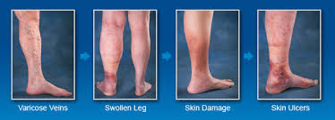 Causes of Leg Swelling