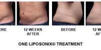 Define and Discuss on Liposonix Treatment