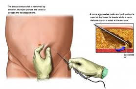 Liposuction Surgery Procedure