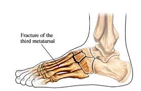 Treatment for Metatarsal Stress Fractures