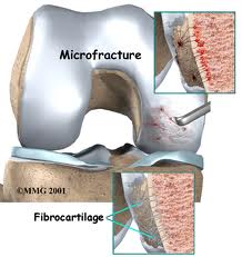 Treatment Procedure of Microfracture Surgery