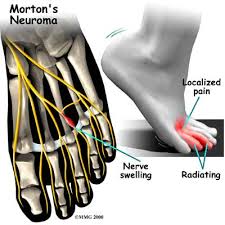 Details about Mortons Neuroma