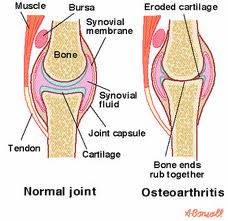Explain Osteoarthritis Treatment of the Knee