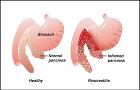 Causes and Symptoms of Pancreatitis