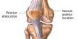 Causes and Prevention Patellar Dislocation