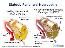 Diabetic Foot Ulcers and Peripheral Neuropathy