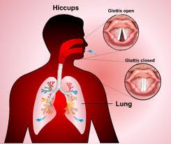 Define and Discuss on Persistent Hiccups
