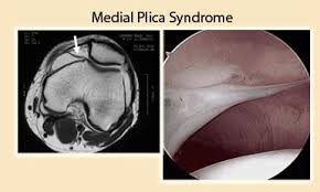 Explain Plica Syndrome of the Knee