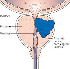 What Should Consider about Prostate Cancer Screening