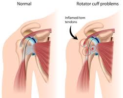 Treatment of Shoulder Ligament Injuries