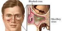 Causes of Sinus Blockage