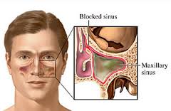 Causes of Sinus Blockage