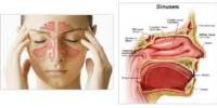 Define and Discuss on Sinus Congestion