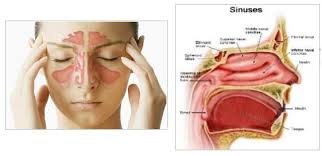 Define and Discuss on Sinus Congestion