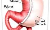Important Facts about Sleeve Gastrectomy