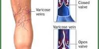 How to Cure Spider Veins