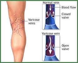 How to Cure Spider Veins