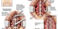 What Should Judge for Spine Surgery