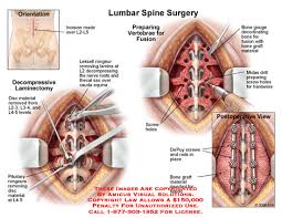 What Should Judge for Spine Surgery