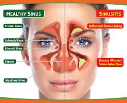 What are the Symptoms of Sinusitis