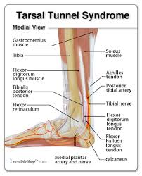 Symptoms and Treatment of Tarsal Tunnel Syndrome