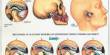 Causes of Temporomandibular Dysfunction