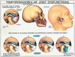 Causes of Temporomandibular Dysfunction