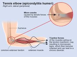 Prevention and Treatment of Tennis Elbow