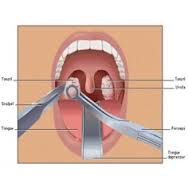 Treatment for Tonsil Stones