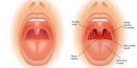 Correct Treatment for Tonsil Stones