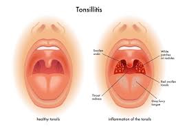 Causes and Treatment of Tonsil Stones