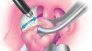Explain Dangers of a Tonsillectomy